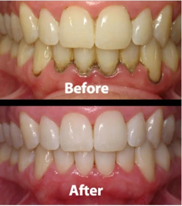 Customer teeth before and after comparison