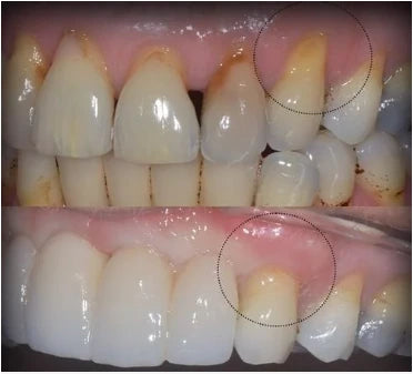 Customer gumline before and after comparison